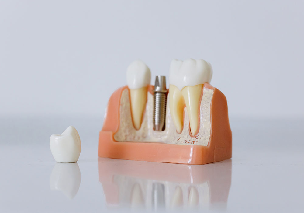 implante dental